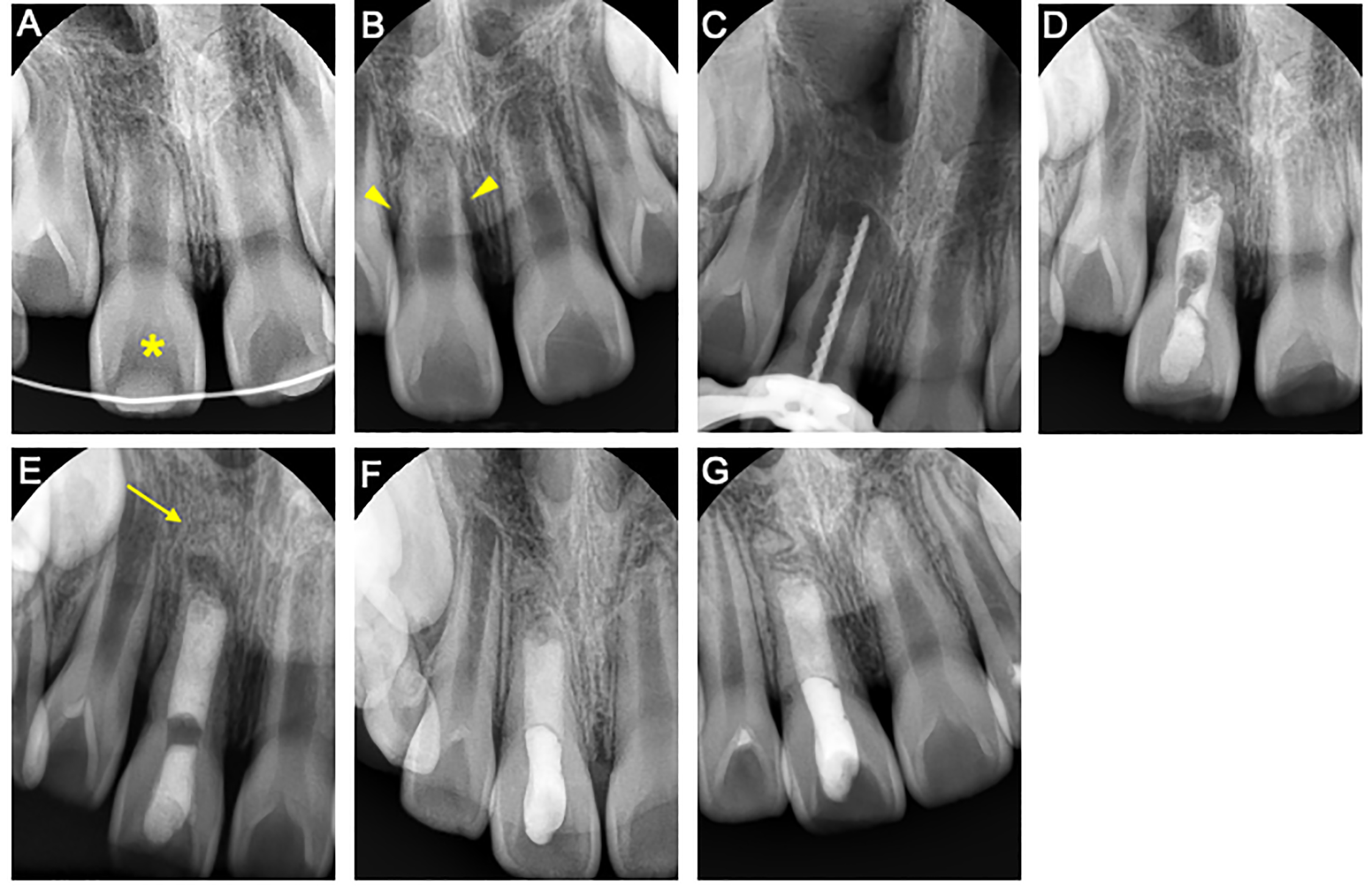 Serial radiographs of case 3. (A) A radiograph of the right
upper central incisor (asterisk) at the first visit. (B,C) Radiographs at 6 weeks
after traumatic injury. (D) A radiograph 4 weeks after intracanal medication. (E)
Postoperative radiographs (E) immediately, (F) 6-month follow-up, and (G) 1-year
follow-up.