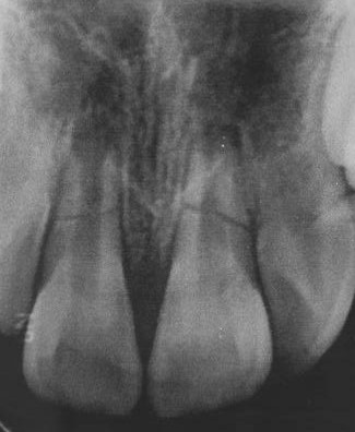Preoperative periapical radiographic showed mid-root fracture 
line of teeth #11 and 21.