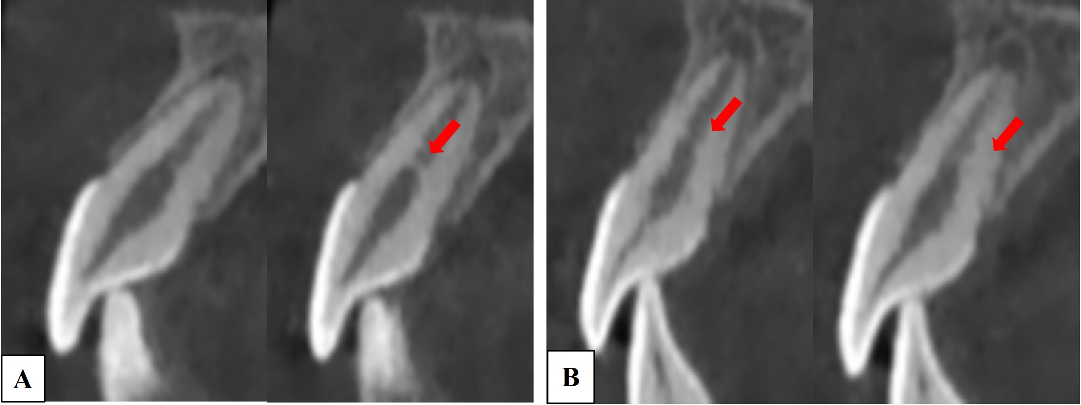 Sagittal CBCT images of different cross-sections of 16-month 
follow-up. The fracture line healed with hard tissues and suspected partial 
calcification at the fracture site in tooth #11 and 21. (A) Tooth #11; (B) Tooth 
#21.