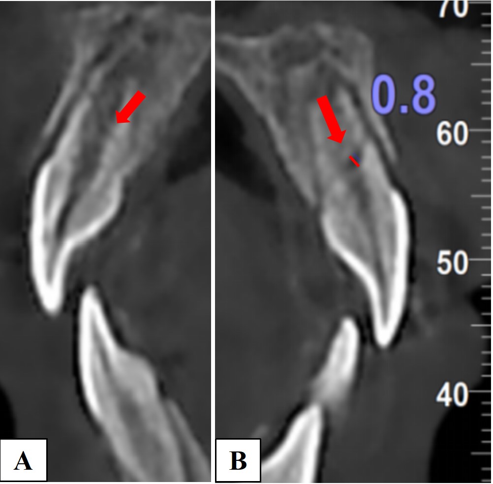 Preoperative CBCT image. (A) Oblique fracture line of tooth #11; 
(B) Oblique fracture line of tooth #21 and a 0.8 mm-width gap between the 
fragments.