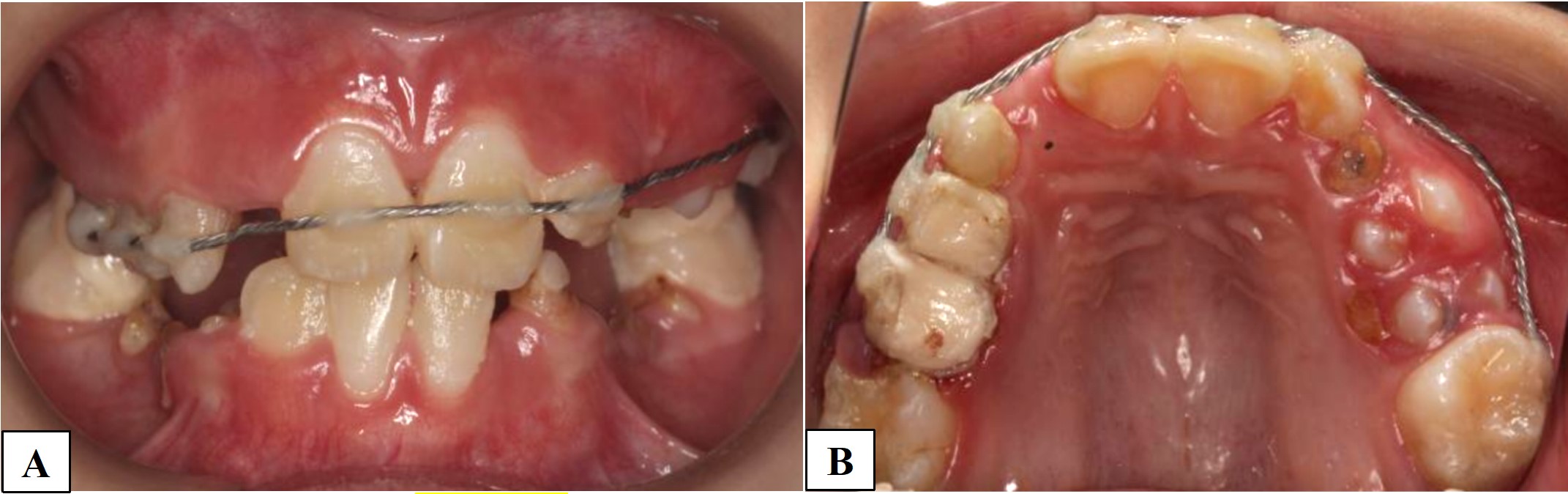 Intraoral view after the first treatment. (A) Repositioned the 
displaced fragment and stabilized the mobile coronal segment; (B) Teeth #53, 54 
and 55 was restored temperorily.
