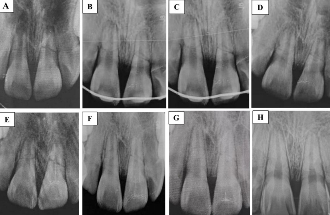 Preoperation and follow-up periapical radiographs: (A) Preoperation, (B) Postoperation, (C) 4 weeks, (D) 7 weeks, (E) 3 months, (F) 5 months, (G) 10 months, (H) 16 months’ follow-up.