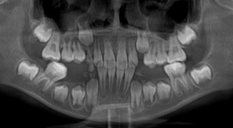 Follow-up images at 16 months showing the panoramic radiography 
of the overall oral health condition and the mesial inclination of tooth #46.
