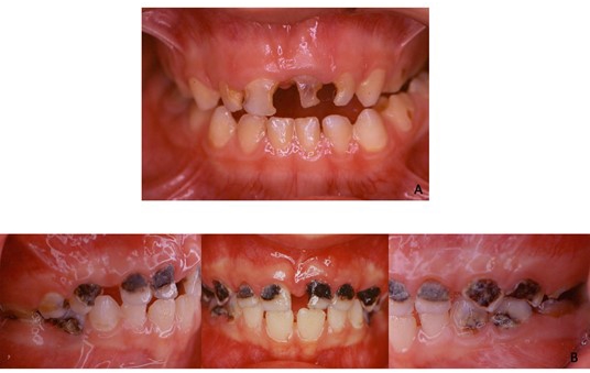 Brown-black cavities. (A)
Intraoral frontal view of 3-year autistic male who shows extensive decays of
primary incisors. (B) Intraoral frontal and lateral views of 2.7-year female who
shows brown-black cavities in the upper and lower arches except for the lower
incisors that not present any caries.