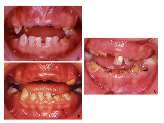 Root stumps. (A) Intraoral
frontal view of 3-year no autistic female who shows extensive decays of primary
dentition and root stumps in the upper and lower arches; the lower primary
incisors, except for the left lateral incisor, appear healthy. (B) Intraoral
frontal view of 3-year female who shows root stumps in the upper and lower
arches; the lower primary teeth are also affected. (C) Intraoral frontal view of
2.5-year autistic female showing root stumps and extensive decay in both
arches.