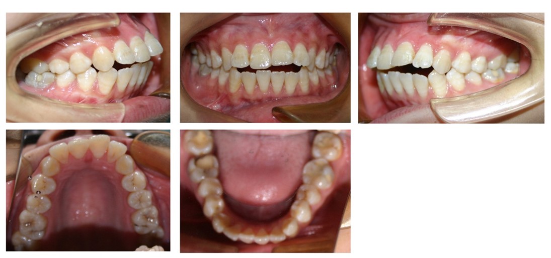 Intra-oral photographs prior to treatment.
