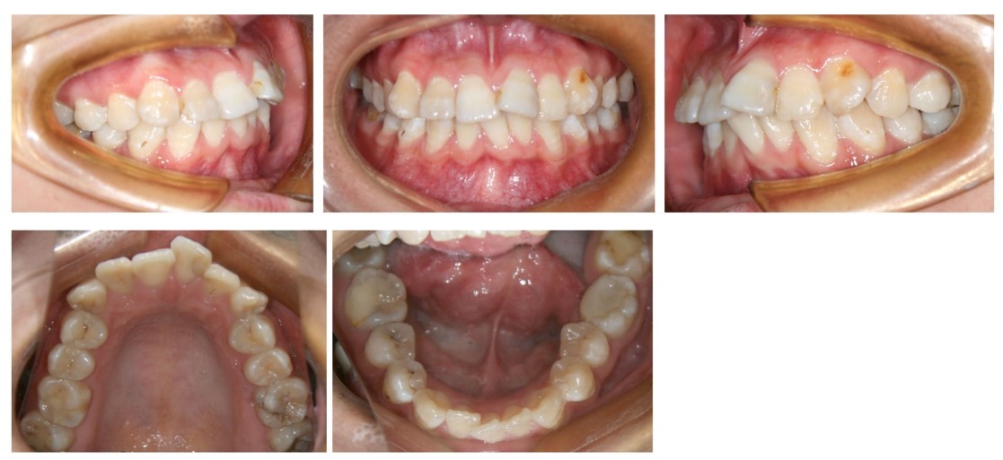 Intra-oral photographs before treatment. Note the congenital
loss of the lower left incisor and the largely-filled lower left first molar.