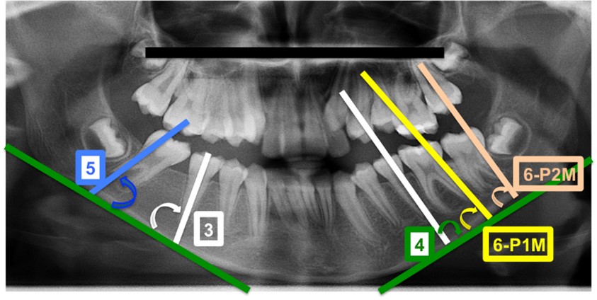 Forming the Angle 3, Angle 4, Angle 5, Angle 6-P1M and Angle 
6-P2M. (Angle 3) White arrow: the distal angle formed between the long axis of 
SP and basis mandible in the extraction side; (Angle 4) Green arrow: the distal 
angle formed between the long axis of SP and basis mandible in the contralateral 
side; (Angle 5) Blue arrow: the mesial angle formed between the long axis of P2M 
and basis mandible in the extraction side; (Angle 6-P1M) Yellow arrow: the mesial 
angle formed between the long axis of P1M and basis mandible in the contralateral 
side; (Angle 6-P2M) Orange arrow: the mesial angle formed between the long axis 
of P2M and basis mandible in the contralateral side. Green line: basis mandible; 
Blue line: long axis of P2M in the extraction side; White lines: long axis of PS; 
Yellow line: long axis of P1M; Orange line: long axis of P2M in the contralateral 
side; Black line: maxillary plane.