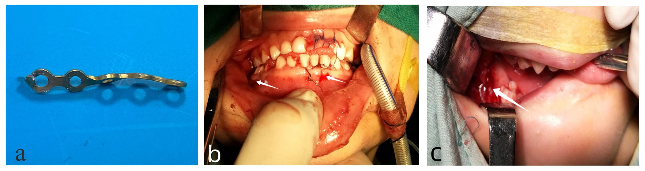 Surgical process. (a) Preformed titanium plates. (b,c) 
Implanted the internal fixation devices.