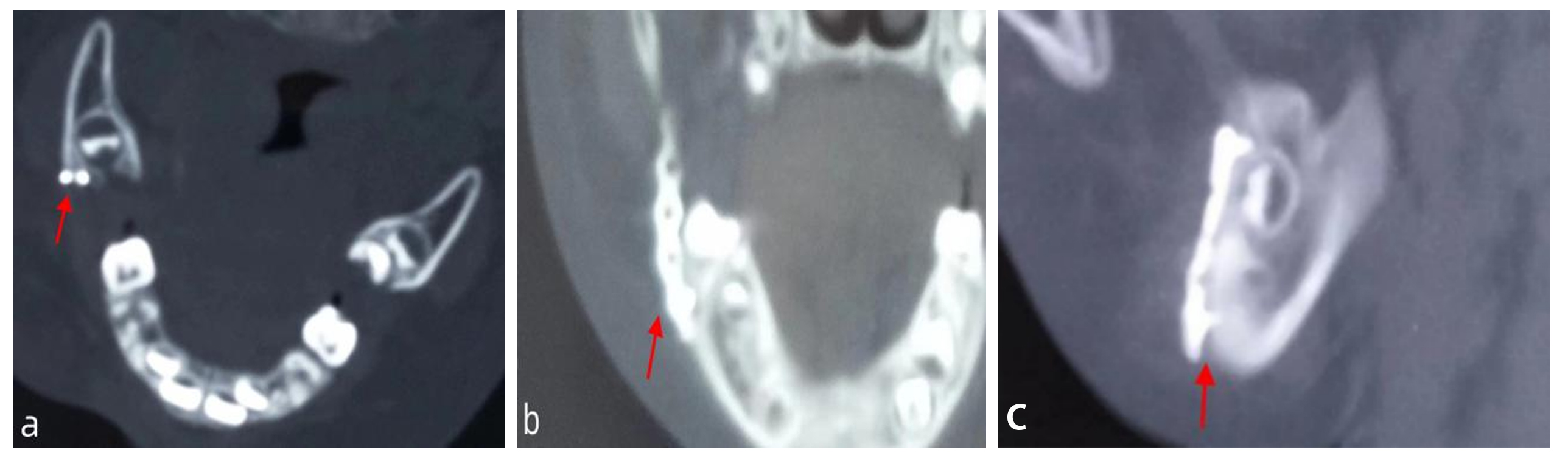 Postoperative radiographic data. (a) Cross-section. (b,c) 
Sagittal plane.