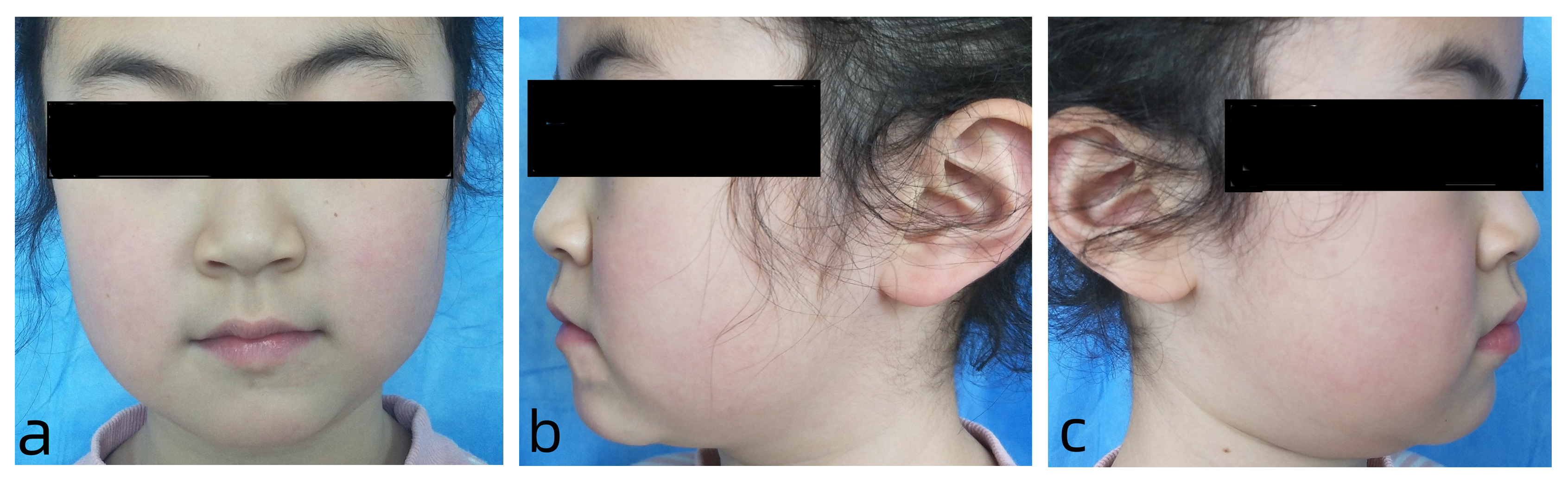 Facial photos. (a) Frontal view. (b,c) Side view.
