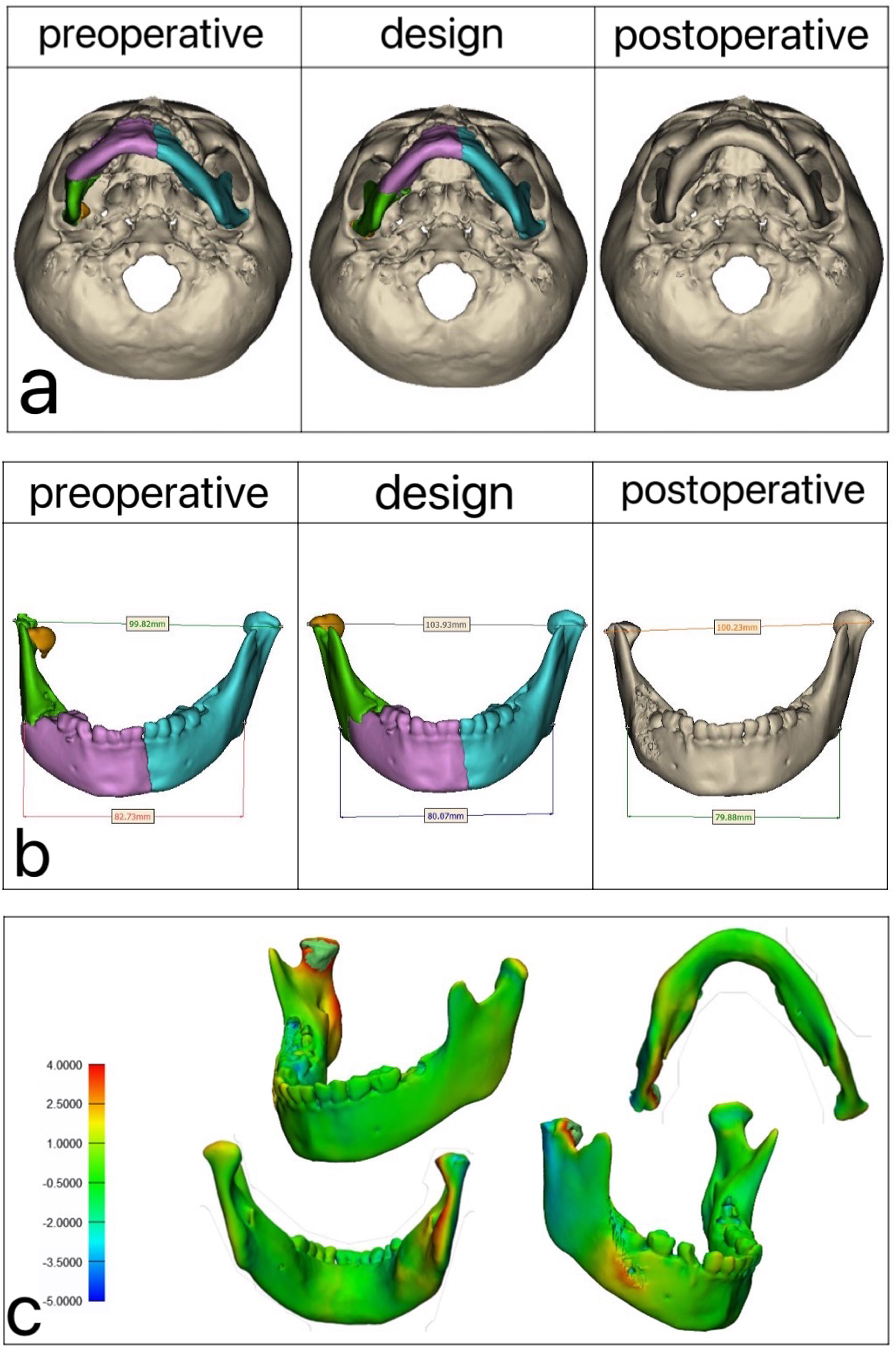 Comparison before and after surgery. (a) Compared with the 
bottom view, (b) Measurements of the distance between the condyle and the 
mandibular angle, and (c) The virtual design before surgery had a high degree of 
fitting with the mandibular shape effect after surgery.