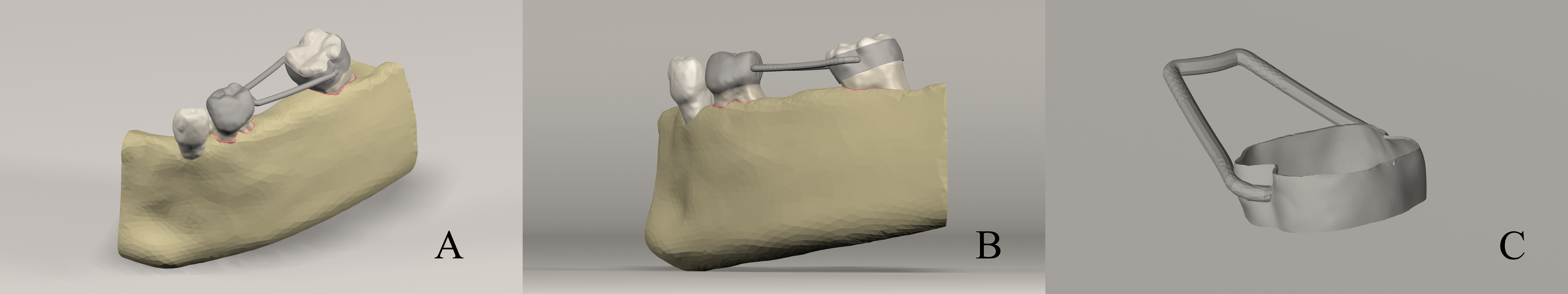 Generated 3D simulation model of test model 1. (A) FSM with
straight arm type. (B) Sagittal view of straight arm FSM. (C) Render Image of
Test Model 1.