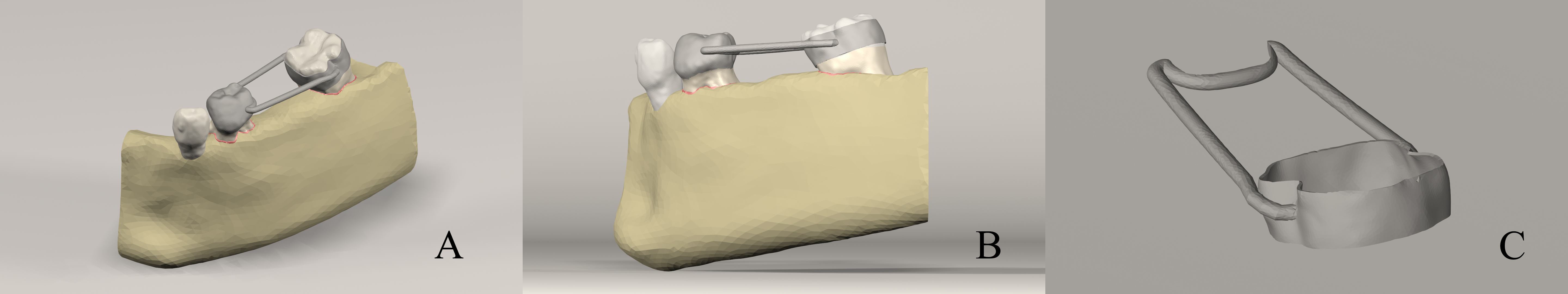 Generated 3D simulation model of test model 2. (A) FSM with
straight and surround-type arms. (B) Sagittal view of FSM. (C) Render Image of
Test Model 2.