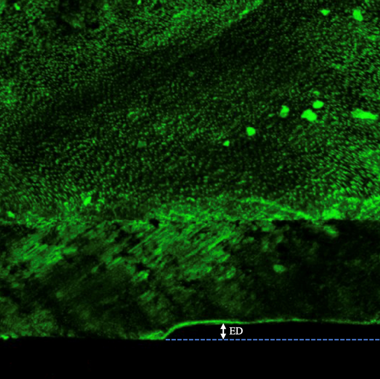 A representative CLSM image of the enamel erosion following the
etching procedure. The black area marked with a white arrow indicates the erosion
depth (ED). CLSM: confocal laser scanning microscopy.
