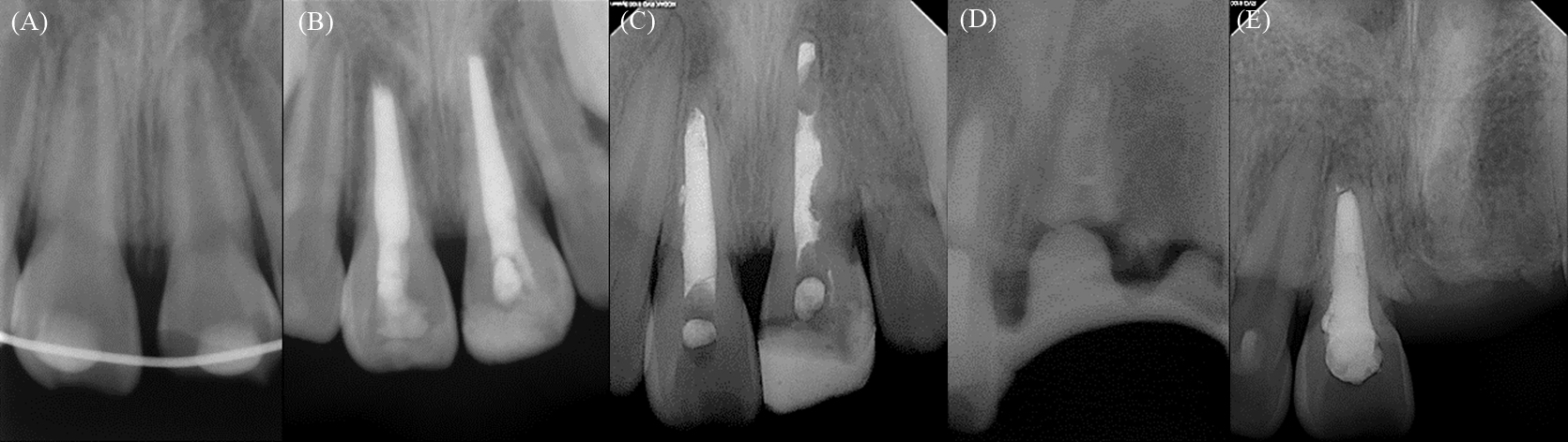 The radiographic view of 
#21, 22. (A) post replantation; (B) after 4 months of follow-up; (C) after 5 
years of follow-up; (D) after decoronation; and (E) after 5 years of 
decoronation.