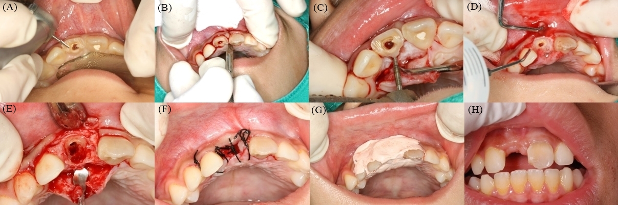 Clinical steps of 
decoronation. (A) Crown reduction up to 1/2 of the height of the crown, removal 
of the filling materials (Ca(OH)2 paste) using a Gates-Glidden bur and 
endodontic files (filing the canal wall using #10 K-file with a pre-curve), and 
irrigation of the root canal using saline, NaOCl, and etylenediamine tetraacetic 
acid (EDTA). Passive ultrasonic irrigation activation with EDTA is effective; (B) 
Elevation of a full thickness mucoperiosteal flap to expose the cementoenamel 
junction (CEJ) of the ankylosed tooth; (C) Removal of the crown from the CEJ on 
the palatal side using a tapered round end diamond bur under continuous saline 
irrigation; (D) Obtaining image after the removal of the crown up to the CEJ; (E) 
Reduction of the coronal part of the root to a level 1.5–2 mm below the marginal 
bone using a round bur and filling the enlarged root canal with blood; (F) 
Placing the mucoperiosteal flap over the unsealed residual root and alveolus, 
followed by wound closure using single sutures; (G) Coe-Pak; and (H) Stich-out.