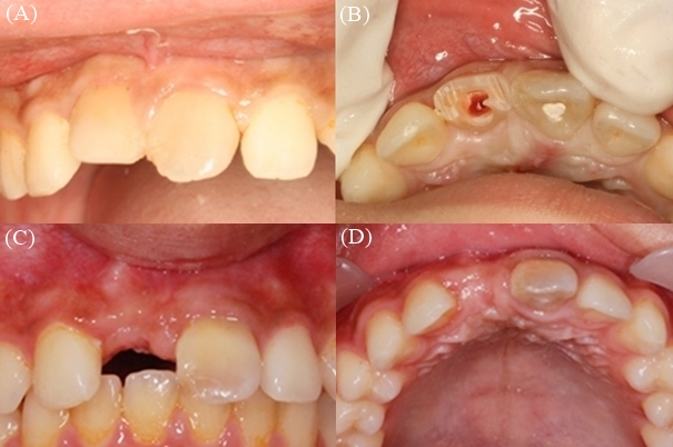 The clinical view of #11. (A) preoperative; (B) decoronation; (C,D) 5 years after decoronation.