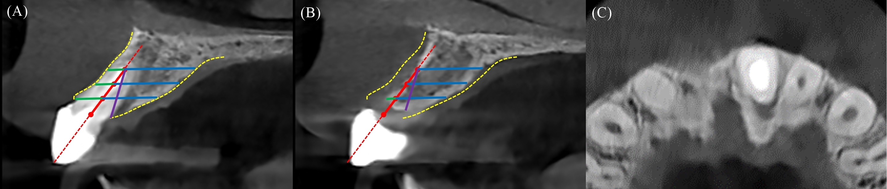 CBCT images of (A) #11 and 
(B) #21 10 years after surgery. Yellow: outline of alveolar bone; red: long 
axis of the tooth (the crestal, middle, and apical points were placed 3 mm, 6 mm, 
9 mm from CEJ, respectively, and lines parallel to the FH plane were drawn at 
each point); green: labial bone width; blue: palatal bone width; and (C) purple: 
alveolar height, measured from the apical point to the palatal alveolar crest. 
(C) CBCT axial view.