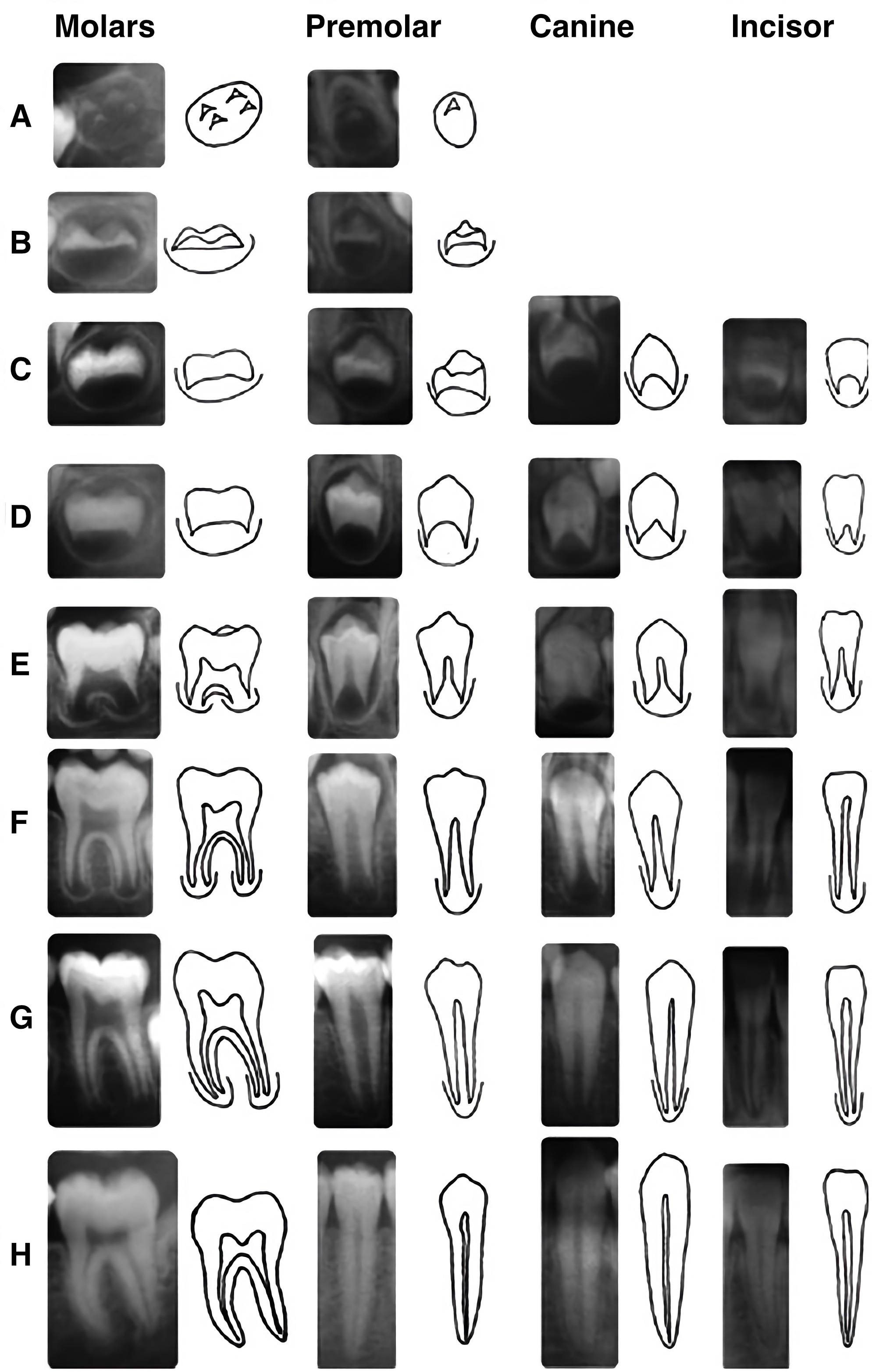 Tooth development stages according to the Demirjian method 
(A–H) [4].