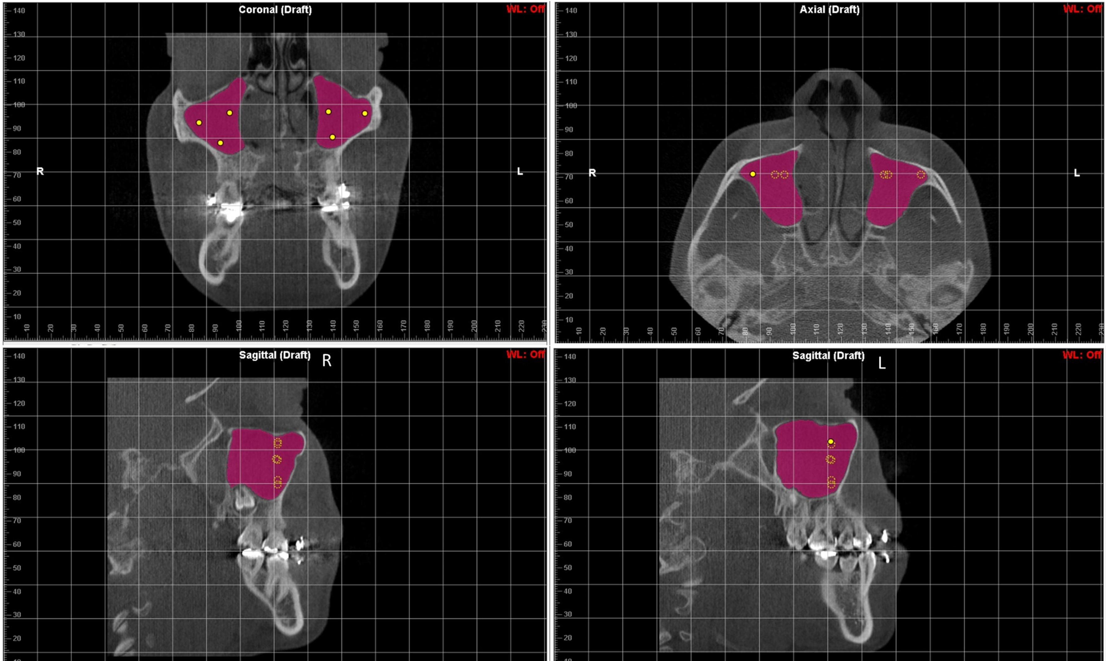 Coronal, axial and sagittal MSV segmentation. Analysis of the 
maxillary sinus on 3D Dolphin 11.95 Imaging software (Dolphin Imaging &amp; 
Management Solutions, Patterson Technology, Chatsworth, CA, USA). Selection of 
the region of interest on 3 space (coronal, sagittal, axial) reference planes and 
then, the initiation seeds were applied to the inner part of the maxillary sinus.
