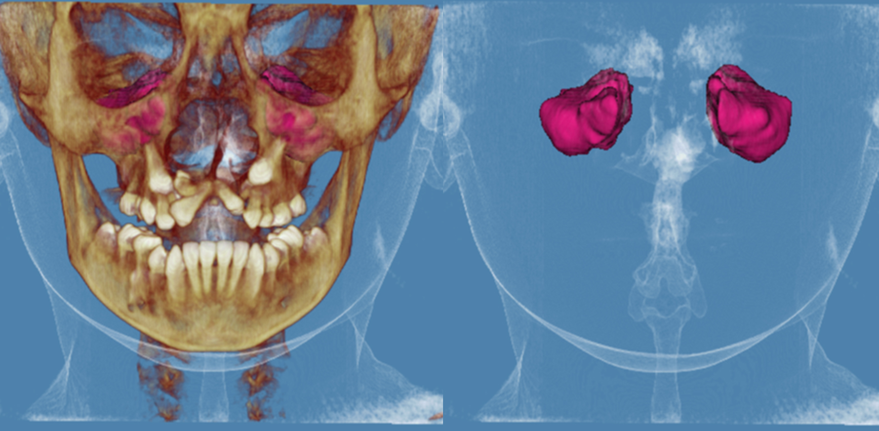3D reconstruction of the bilateral cleft lip and palate patient 
and maxillary sinus volume demonstration. The process involves generating a 3D 
image by assembling adapted slices, which are subsequently used by the software 
to calculate the volume of both the right and left maxillary sinuses in cubic 
millimeters (mm3). This results in a detailed 3D anatomical model for 
analysis.