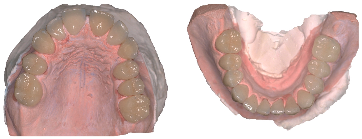 Models with nanoceramic resin crowns.