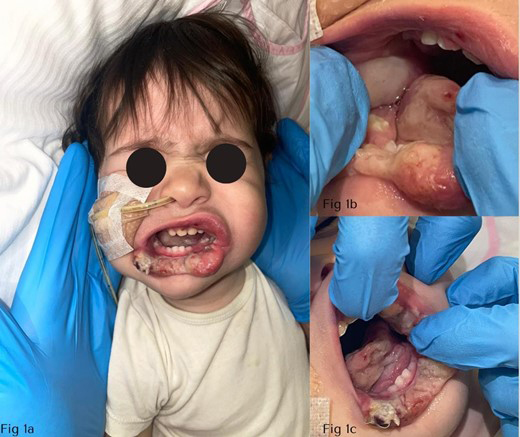 Clinical observation. (1a) extraoral clinical photography of the face. (1b) intraoral clinical photography of the lower lip. (1c) intraoral clinical photography with evidence on the cheek mucosa, lower lip and lingual apex.