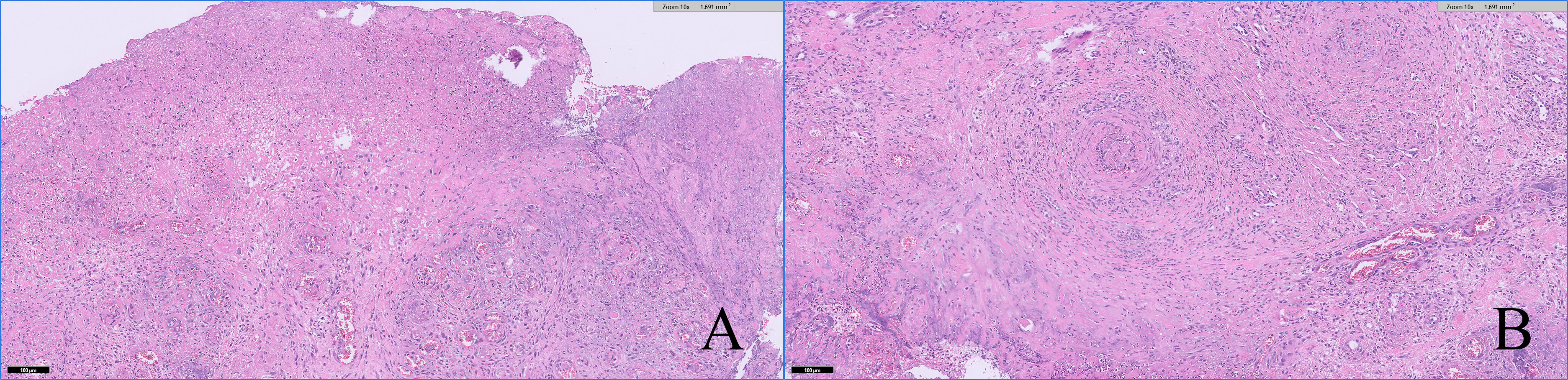 HE staining. (A) At lower magnification, the biopsy showed 
ulceration of the labial mucosa and diffuse necrosis extending through the deeper 
layers. (B) At higher magnification, a brisk chronic and acute inflammatory 
infiltrate was present, and involvement of arterial vessels with transmural 
vasculitis and thrombosis was noted.