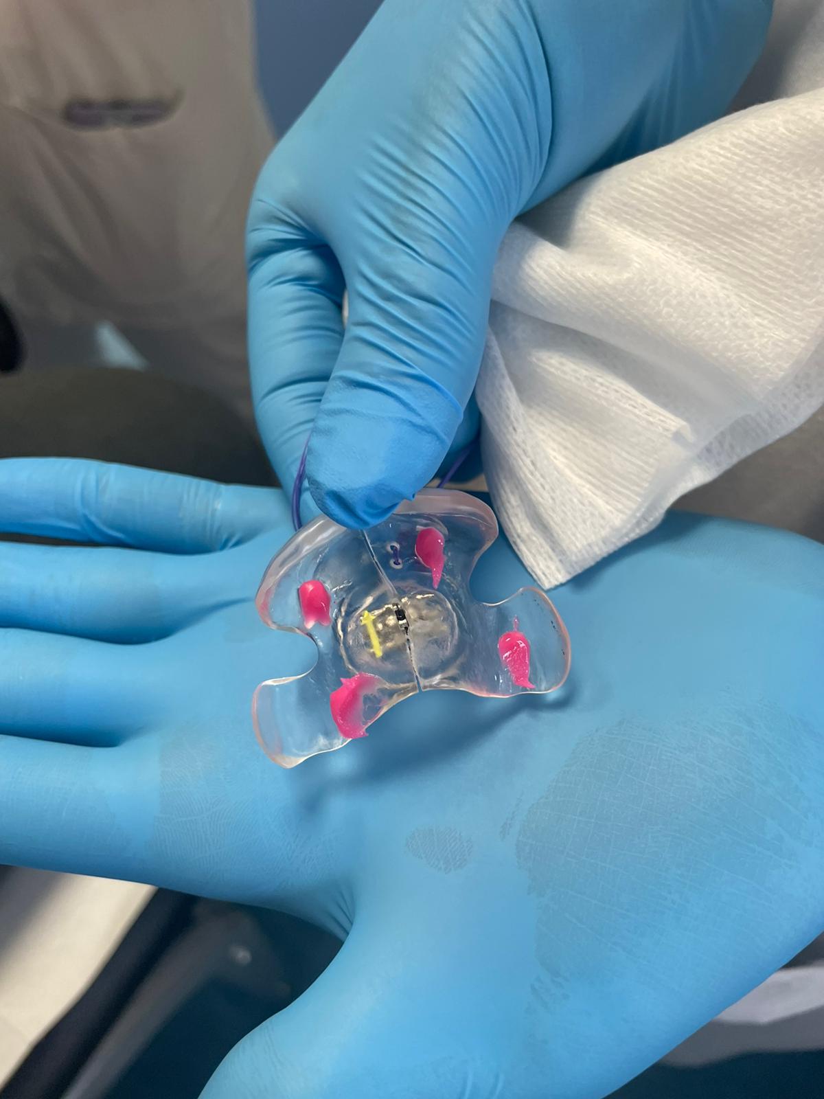 The palatal plate in addition to denture adhesive. The addition 
of the central screw is useful to increase the stability during the patient’s 
growing up.