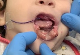 The healing after 4 days from the insertion of the plate. Fibrin 
has started to cover the ulcerated areas.