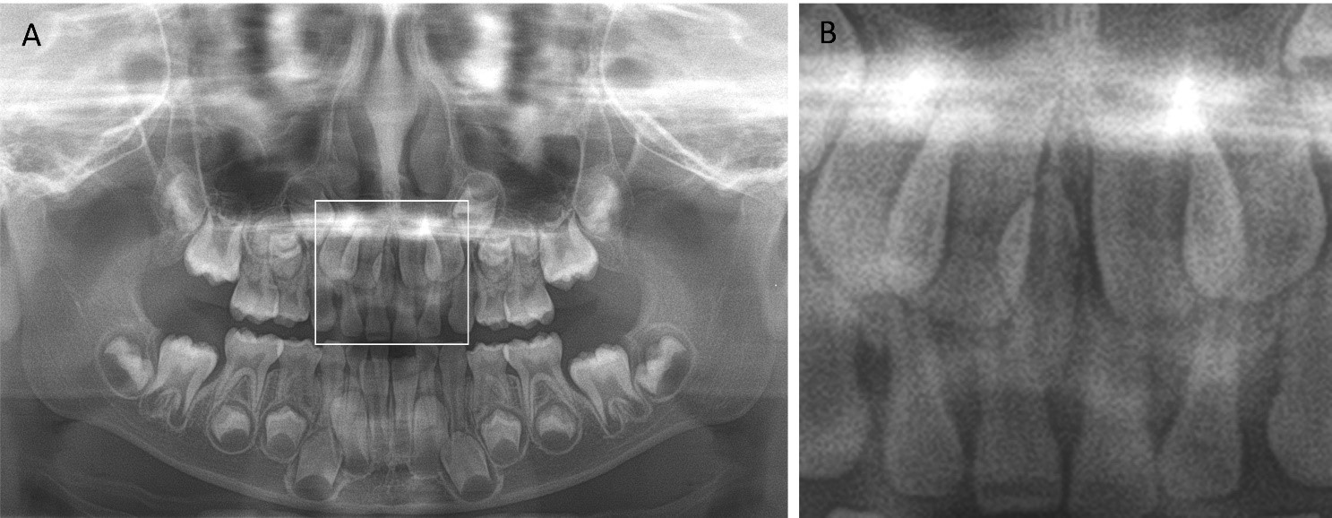 Region of interest (ROI). (A) Panoramic radiograph with an ROI
bounding box. (B) Cropped image from a panoramic radiograph.