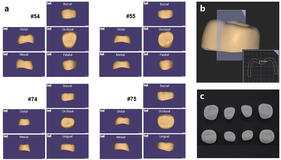 The design and the final restoration of 3D-printed resin crowns.
(a) The design of maxillary right first, maxillary right second, mandibular left
first, and mandibular left second molars. The opposite side of the dentition is
designed with mirror symmetry. (b) The resin crown is designed with a regular
thickness of 0.641 mm. (c) The final restoration of 3D-printed resin, of size 5,
after polishing and before sterilization.