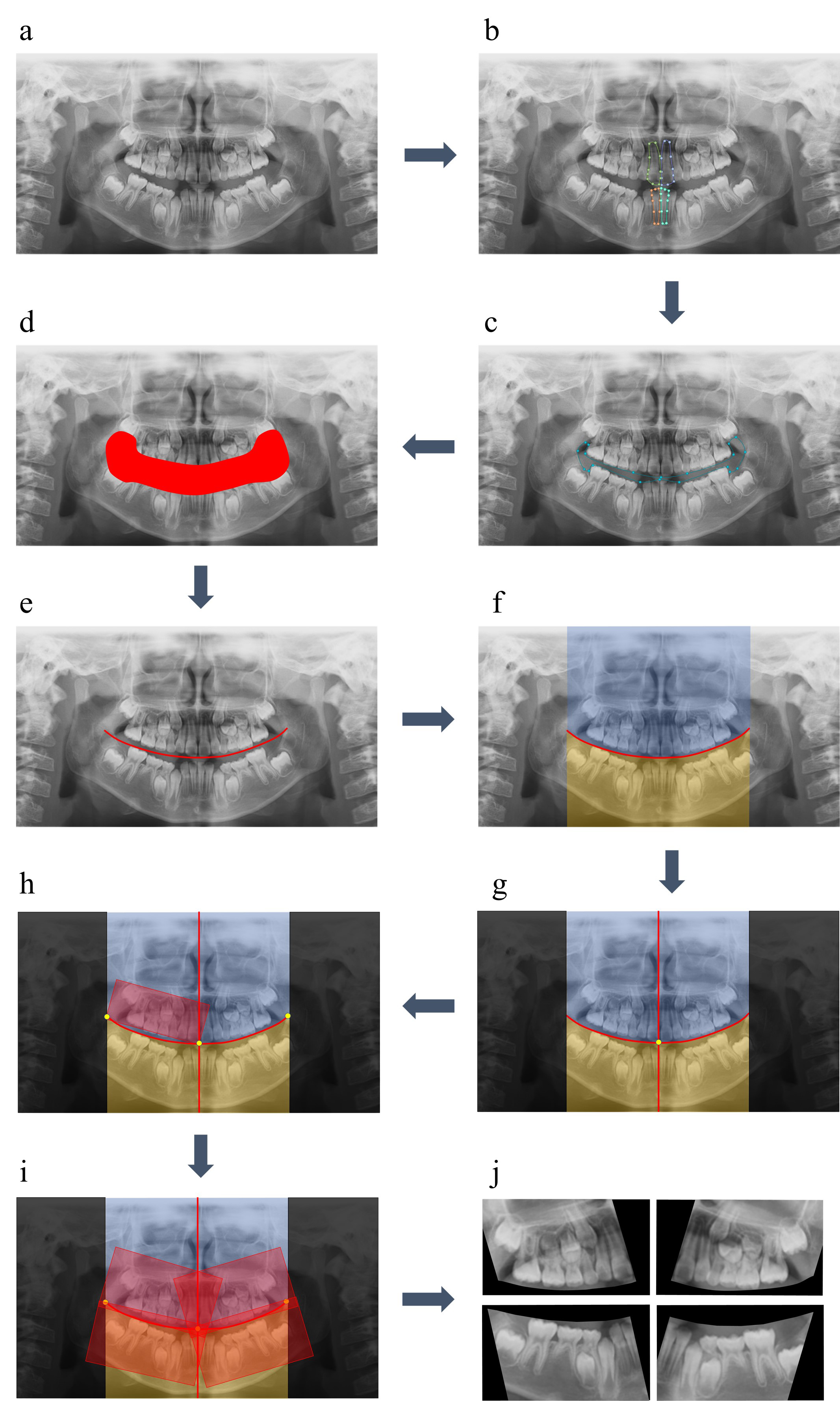 Total flow of region of interest (ROI) setting. (a) Initial
panoramic radiograph. (b) Labeling of anterior teeth. (c) Labeling of interdental
space. (d) Dilation and smoothing of interdental space. (e) Skeletonization and
stretch of interdental space, making horizontal baseline. (f) Setting the initial
regions of the maxilla and mandible. (g) Exclusion of information outside the
horizontal baseline and establishment of the vertical baseline. (h) Initial
setting of ROI. (i) The final ROI with the width increased by 1.2 times and the
height by 1.5 times. (j) Four final data for each quadrant from a single
panoramic image.