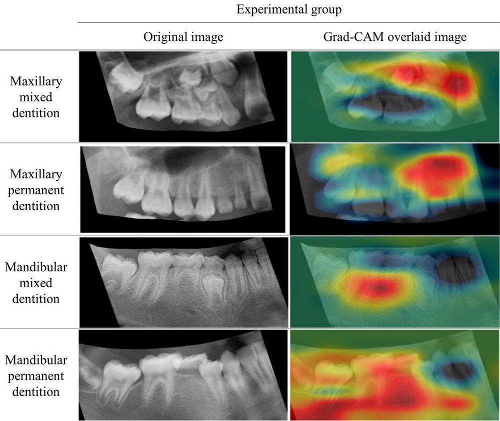 Grad-CAM overlaid images of the experimental group. The color
from blue to red means more activation. Grad-CAM: gradient-weighted class
activation mapping.