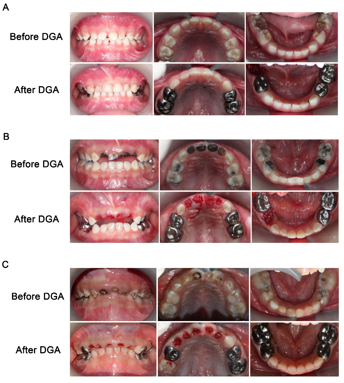 Oral condition of patients before and after DGA. (A–C)
Intraoral view of 3 patients before and immediately after DGA.