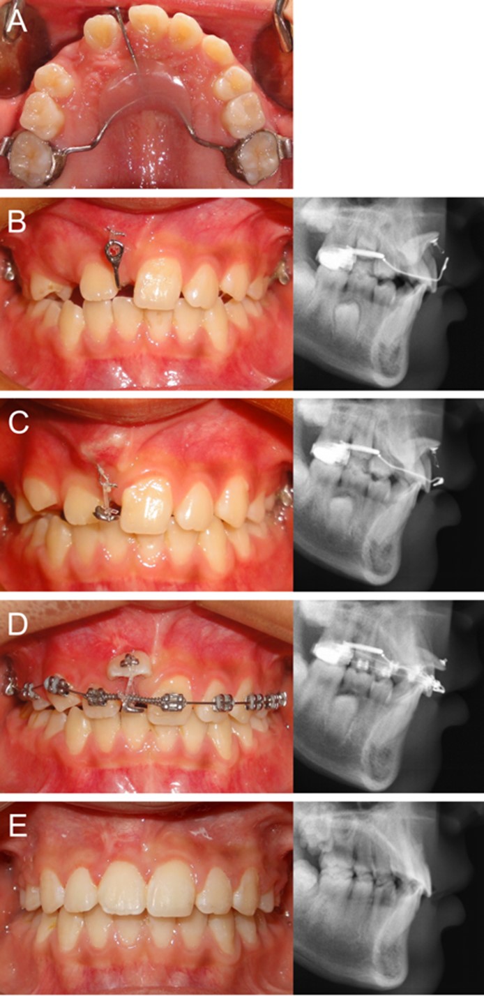 Guide rod appliance used in treating a LIIMCI. (A) Occlusal
view of Guide rod appliance. (B) Postsurgical view after a button was bonded to
the crown and tied to the Guide rod appliance with orthodontic elastomeric chain.
(C) The hook adjusted according to the direction of the crown shown in the X-ray.
(D) Crown exposure, and the button rebonded on the labial aspect, with
simultaneous space opening. (E) The erupting incisor was properly aligned in the
dental arch.