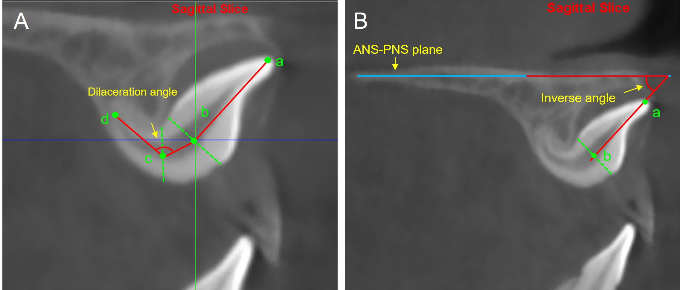 Illustration of measurements used for the morphological description of LIIMCIs at T1. (A) Sagittal slice passes through the long axis of the tooth. (B) Sagittal slice is parallel to the midsagittal plane. a, incisal edge of the maxillary central incisor; b, midpoint of line connecting the cementoenamel junction (CEJ) on the labial and palatal aspects; c, midpoint of line where the root bends; d, root apex of maxillary central incisor. ANS: anterior nasal spine; PNS: posterior nasal spine.