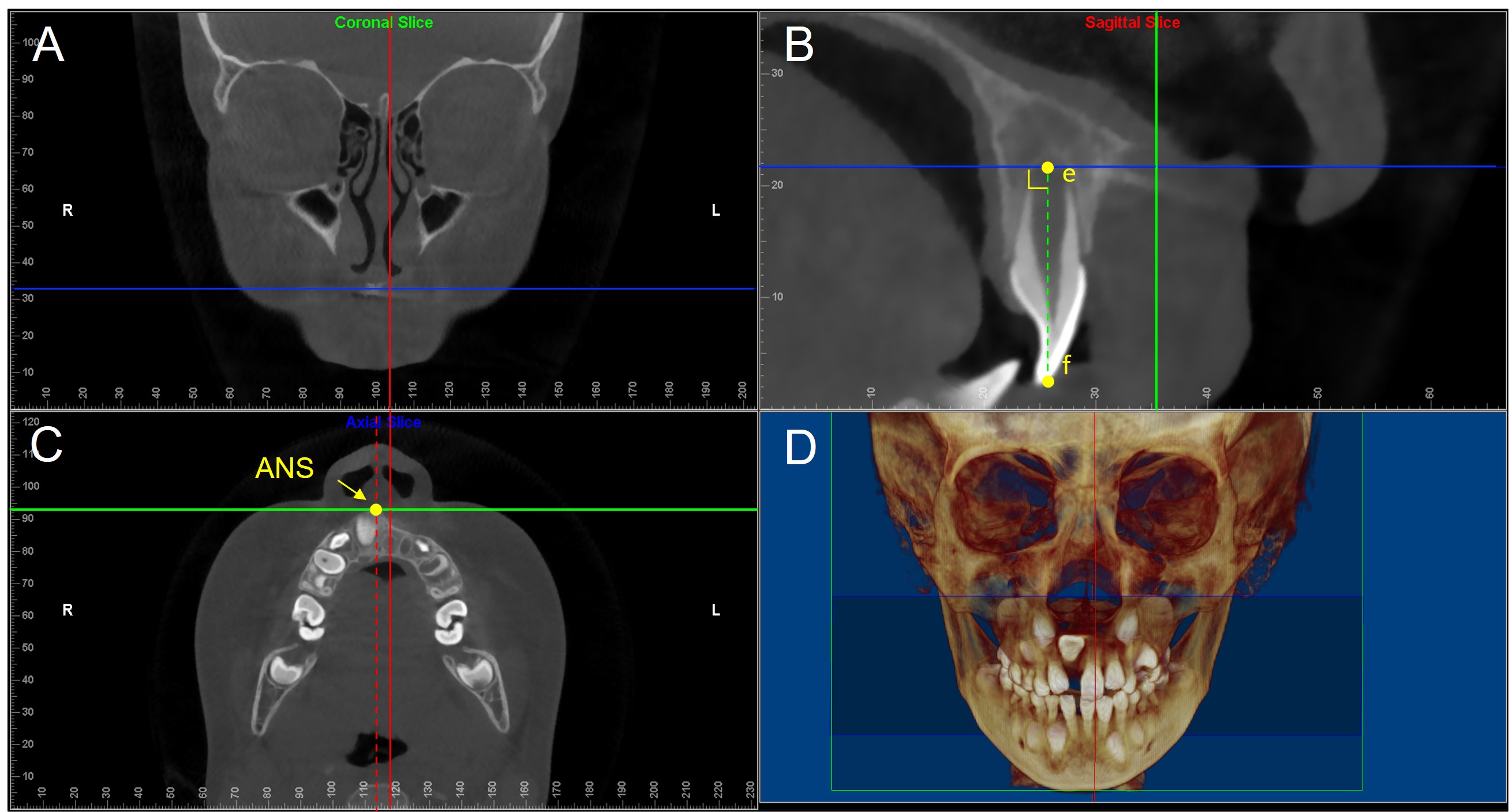 Illustration of the measurement reference planes of the alveolar bone. This figure was captured from a CBCT image of one patient at T1. (A) Coronal section slice. (B) Sagittal section slice is parallel to the midsagittal plane and passes the maxillary contralateral incisor, on which the incisor has a maximum labial-lingual width. e, root apex of contralateral incisor in sagittal slice; f, incisal edge of incisor in sagittal slice; ef, tooth measurement long axis, vertically to the initial measurement plane (IMP). (C) Axial section slice, corresponding to IMP, vertically to midsagittal plane (red dotted line) and ef, and passing through the anterior nasal spine (ANS) point. (D) 3D reconstruction of the maxillofacial region.