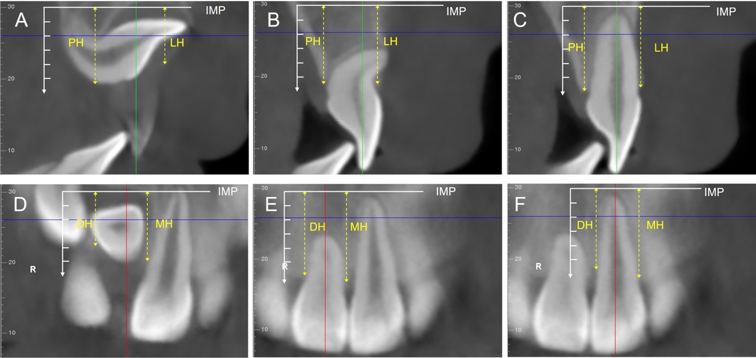 Illustration of alveolar bone height measurements. (A,D)
Sagittal slice in impacted quadrant at T1. (B,E) Sagittal slice in impacted side
at T2. (C,F) Sagittal slice in contralateral side at T2. (A–C) LH, vertical
distance from labial alveolar bone crest to IMP represents labial alveolar bone
height; PH, vertical distance from palatal alveolar bone crest to IMP represents
palatal alveolar bone height. (D–F) MH, vertical distance from mesial alveolar
bone crest to IMP represents mesial alveolar bone height; DH, vertical distance
from distal alveolar bone crest to IMP represents distal alveolar bone height.
IMP: initial measurement plane.