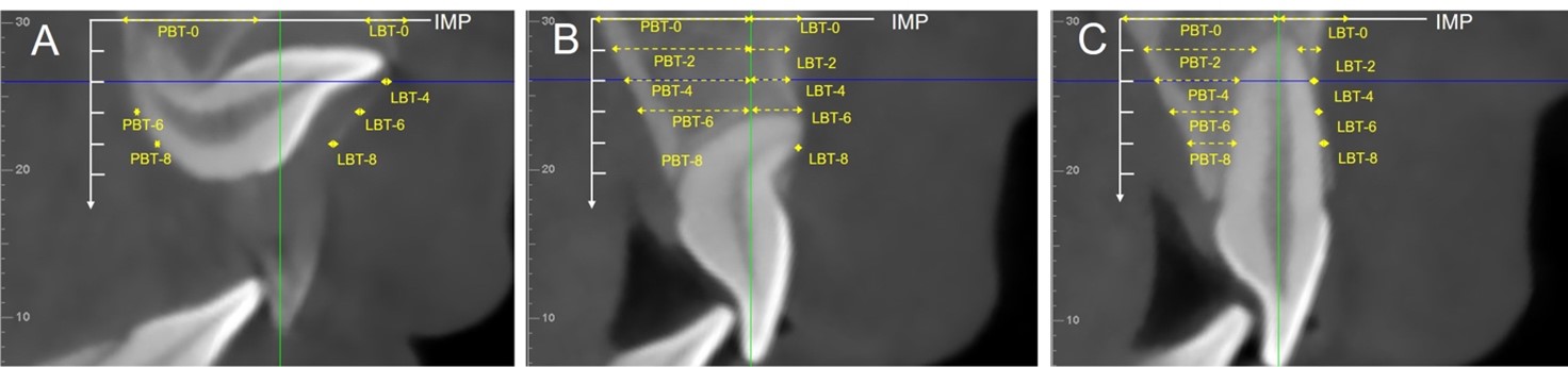 Illustration of alveolar bone thickness measurements used in
this study. (A) Sagittal slice in impacted side at T1. (B) Sagittal slice in
impacted side at T2. (C) Sagittal slice in contralateral side at T2.
LBT-0/2/4/6/8 mm, labial alveolar bone thickness every 0/2/4/6/8 mm below the
IMP; PBT-0/2/4/6/8 mm, palatal alveolar bone thickness every 0/2/4/6/8 mm below
the IMP. IMP: initial measurement plane.