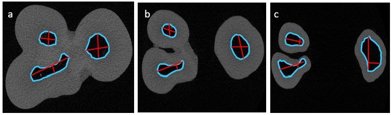 Micro-CT images in (a) the coronal, (b)
the middle, and (c) the apical third of the root canal.