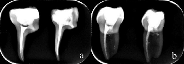 Periapical radiography of root canal fillings. (a) Buccolingual
periapical radiography. (b) Mesiodistal periapical radiography.