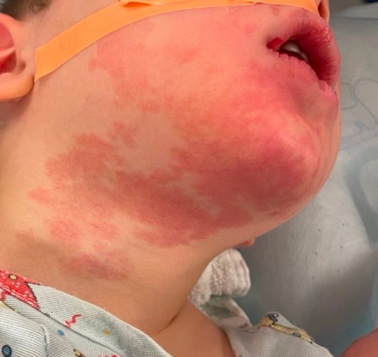 Extra-oral image depicting distribution of hemangioma of right
cheek, chin and neck.
