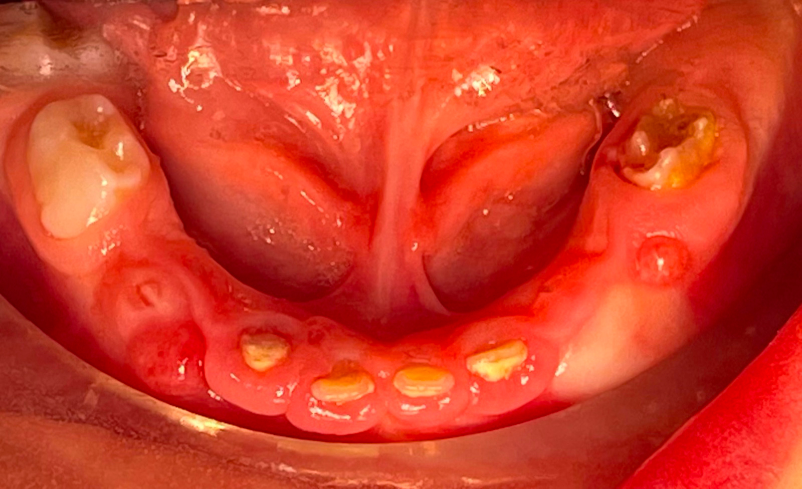 Intra-oral photo of mandibular arch prior to treatment.
Dysplastic and partially erupted teeth in the anterior and lower right regions.
Buccal abscesses are present on the left and right.