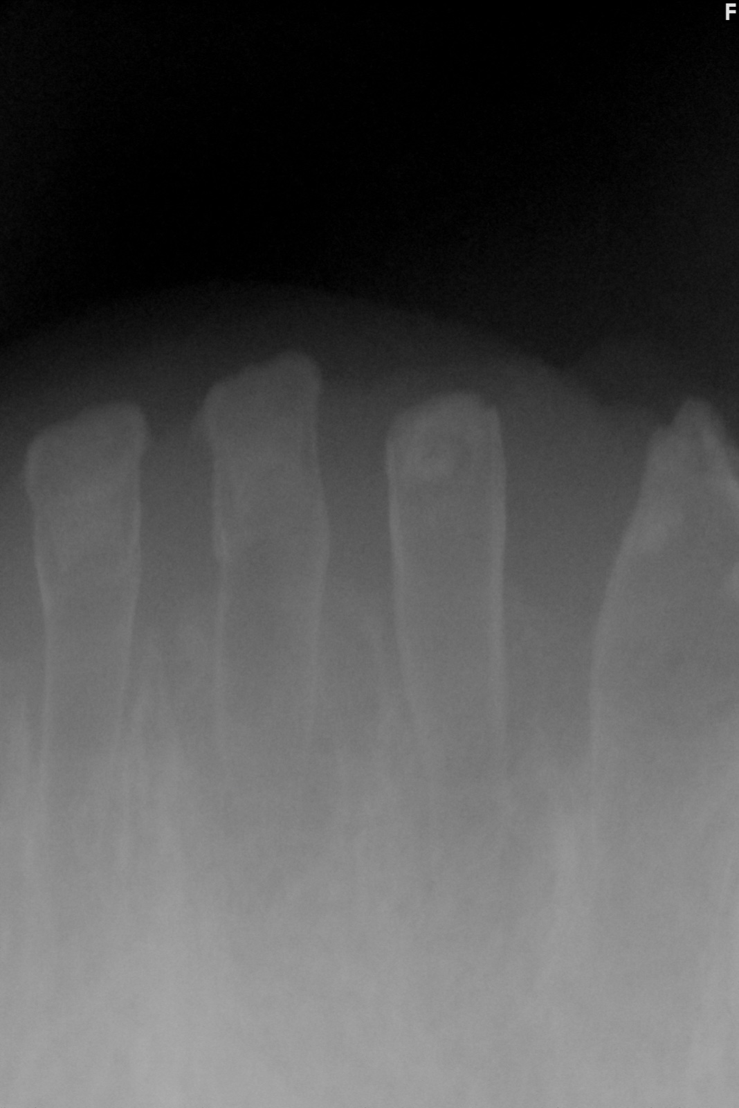Lower anterior periodical radiograph. All lower anterior primary
incisors are dysplastic. The permanent successors do not appear to be present.