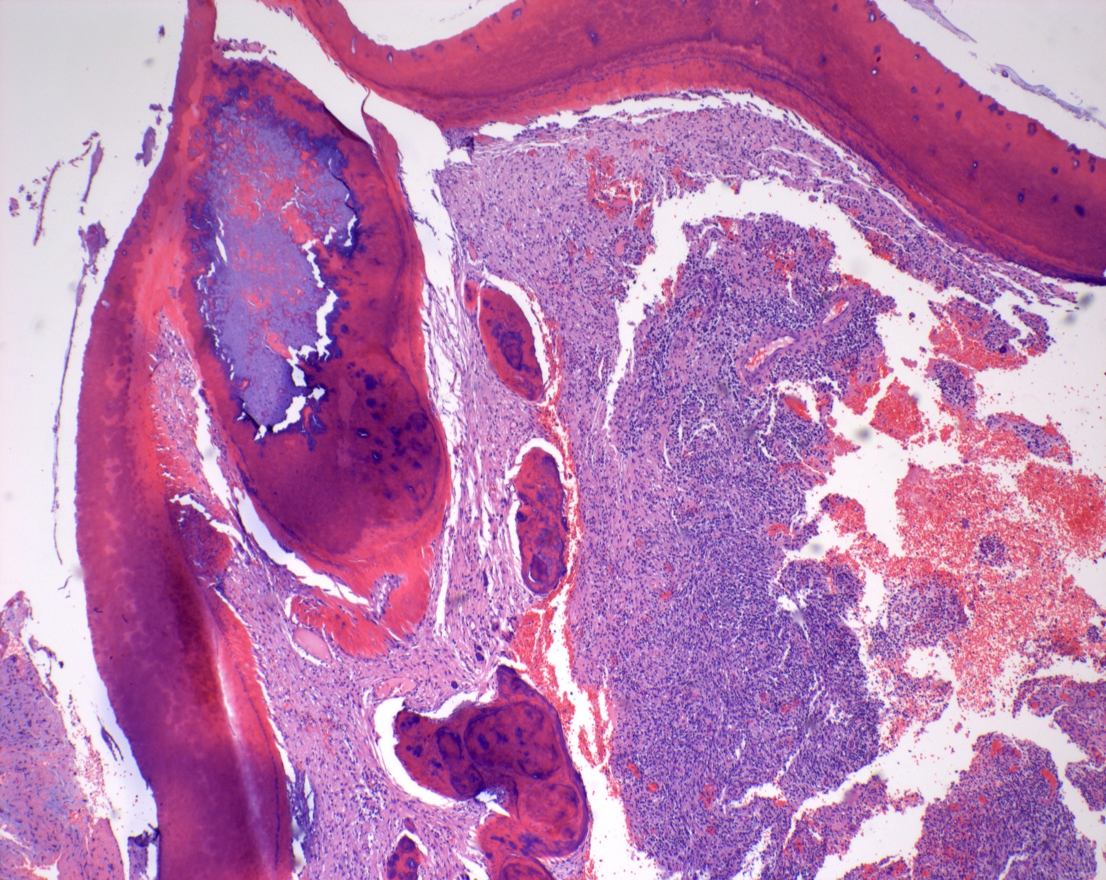 Histological section of extracted primary tooth. The tooth has
been decalcified and the enamel is not present. The dentin is thin, malformed
dentin is present under the cusp tip, and pulpal inflammation with abscess is
present.