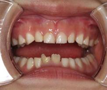 The arrow shows the crown fracture at tooth no: 41.