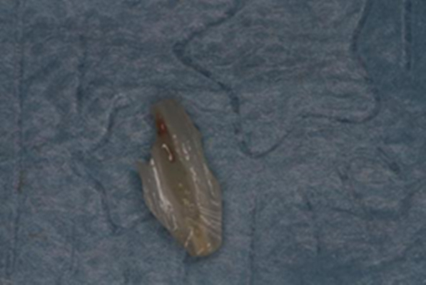 The tooth no: 72 was extracted and the arrow shows the separated
pulp tissue.