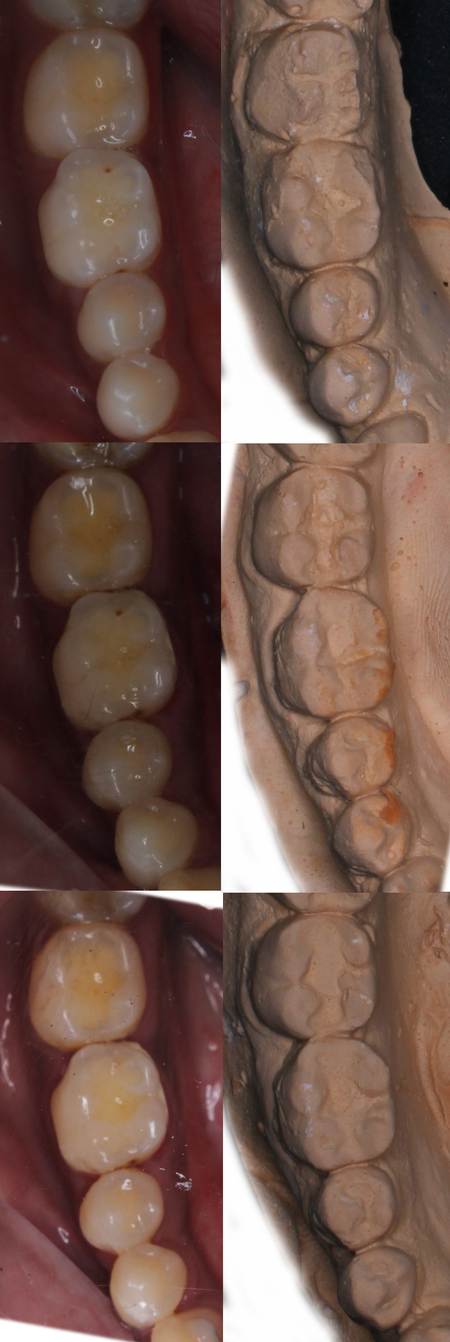Representative cast images and their equivalent
clinical photographs of the interproximal contacts at pre-treatment, post
treatment and one-year post treatment of the mandibular posterior region.